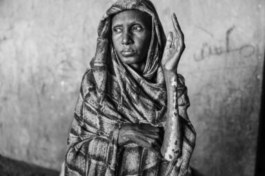 Alhaja Abdallah, a displaced woman from Bara, shows her scars from a fire at Al-Mohad camp in El-Obeid, Sudan, December 10, 2025. The RSF Paramilitary forces have set multiple displacement camps ablaze. Photo by Abdulmonam Eassa (Le Monde)